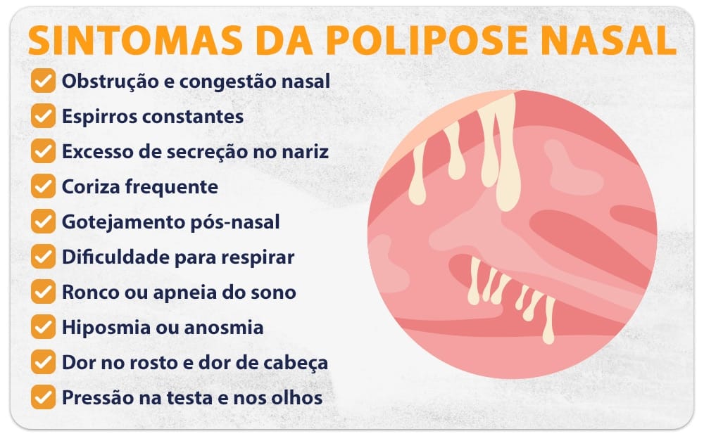 Sintomas da polipose nasal
Obstrução e congestão nasal 
Espirros constantes 
Excesso de secreção no nariz
Coriza frequente
Gotejamento pós-nasal 
Dificuldade para respirar
Ronco ou apneia do sono
Hiposmia ou anosmia
Dor no rosto e dor de cabeça   
Pressão na testa e nos olhos
