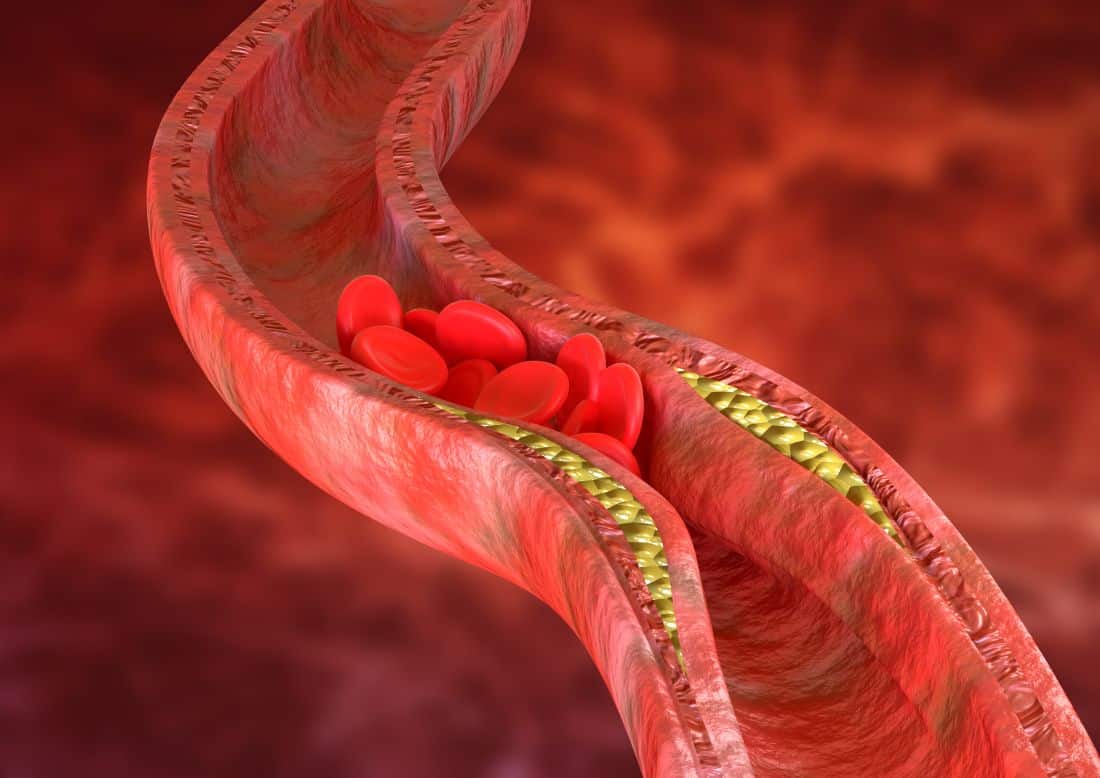 Representação 3D de artéria com placas de gordura ilustrando os riscos que o colesterol alto pode causar no corpo, inclusive no sistema cardiovascular.